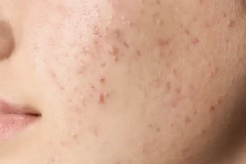 Acne + Congestion