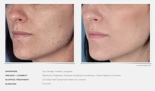 Sun damage + freckles