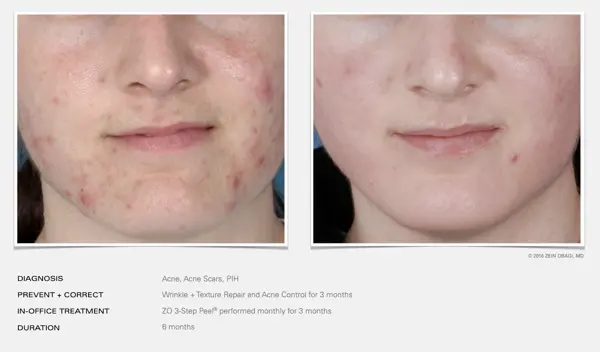 Melasma
