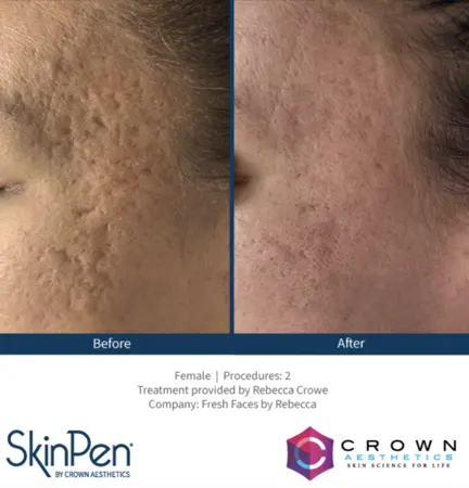 Acne scarring